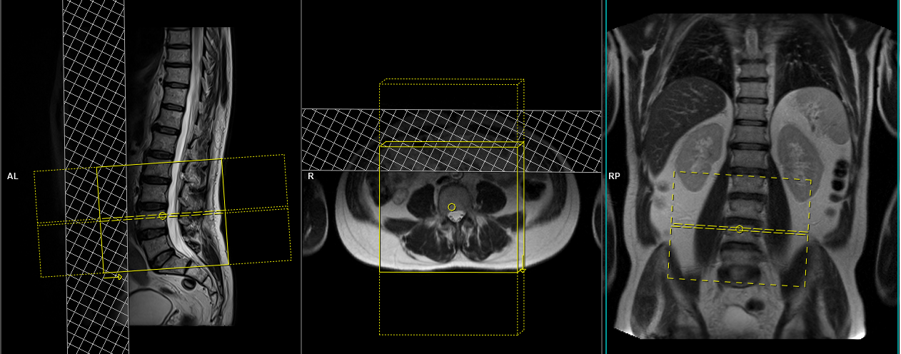 Lumbar lumbosacral Spine MRI Planning And Protocols Indications For 