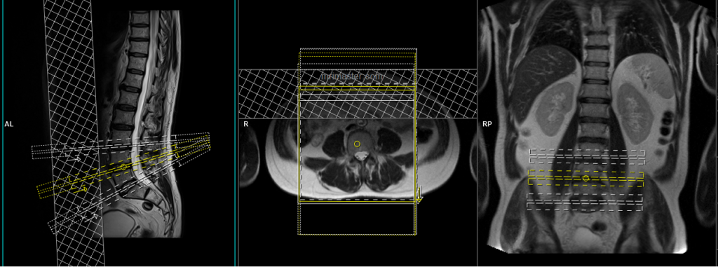 Whole spine MRI planning and protocol of lumbar spine axial multi slice multi angle planning