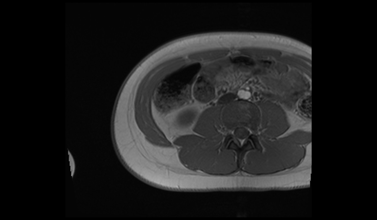 appendix mri T1 axiall image 1
