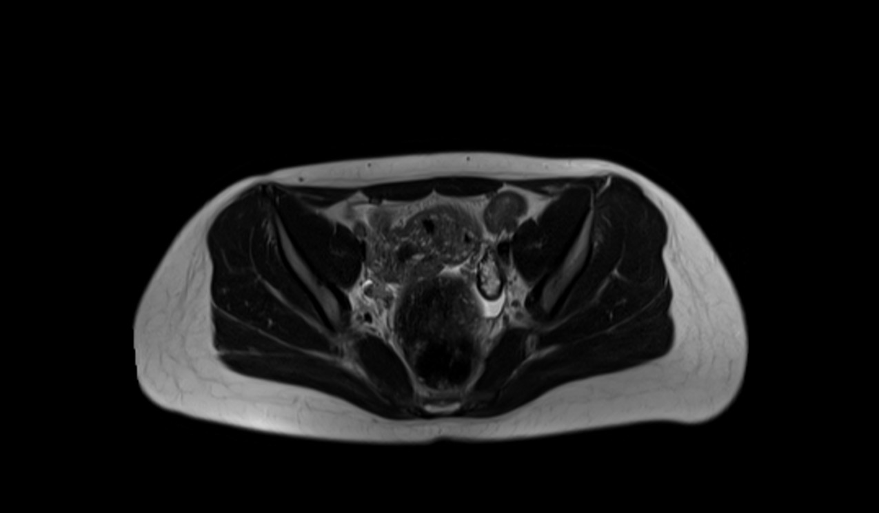 appendix MRI HASTE axial image