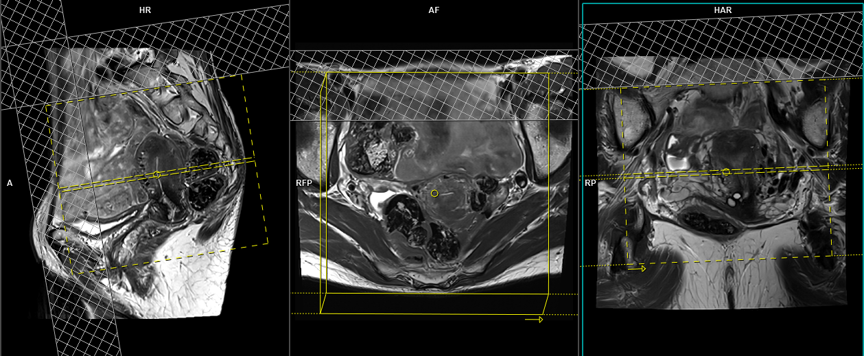 Mri Of The Female Pelvis Mri Of The Female Pelvis