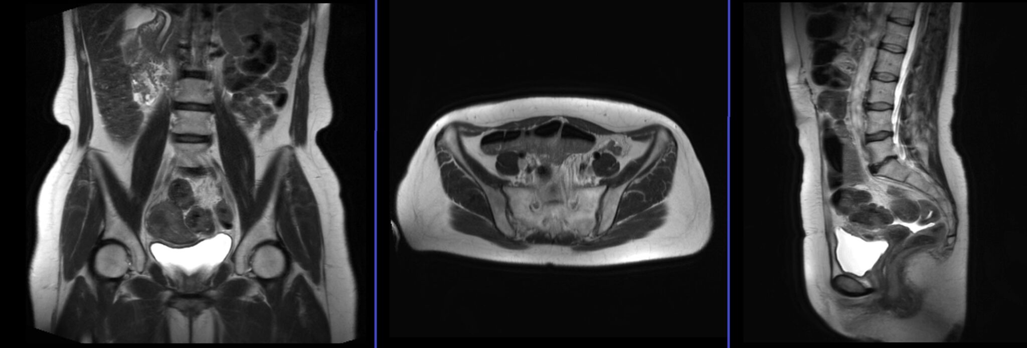 Endometriosis Mri Endometriosis Mri Protocol And Planning 9933