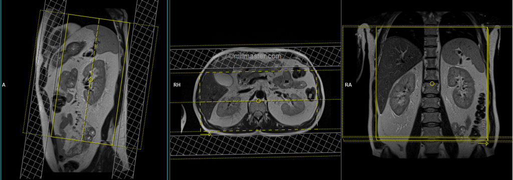 mri adrenal gland protocol and planning of coronal vibe Dixon scans