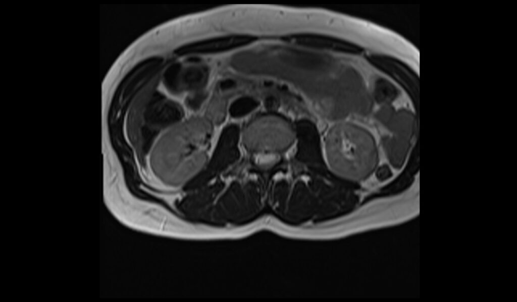 MRI kidneys T2 tse axial images