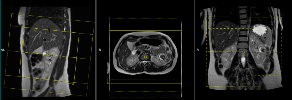 mri kidney scan axial planning and protocol image