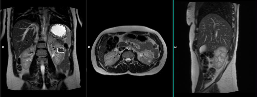 mri kidney scan localiser image