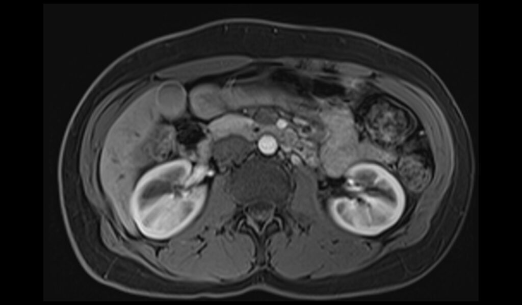 MRI kidneys post contrast T1 DIXON axial images