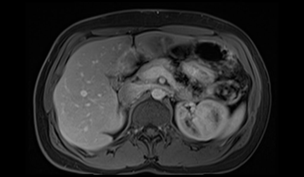 PLAN MRI KIDNEYS T1 VIBE AXIAL POST nephrographic phase - mrimaster