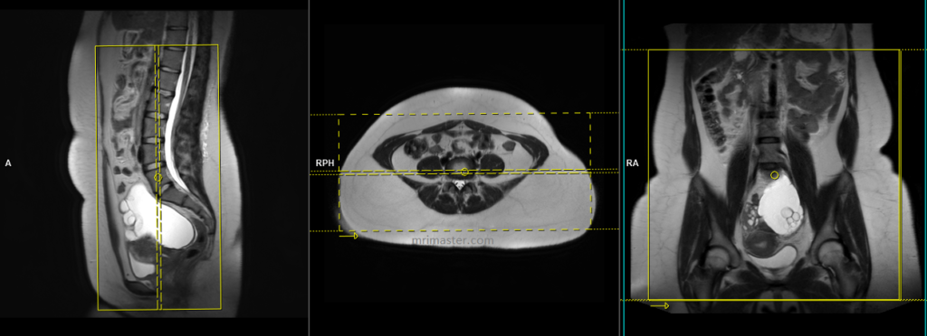 mri ovarian cancer.cyst.adnexal masses planning and protocol of large FOV coronal abdomen and pelvic scans
