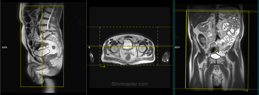 mri penis coronal large FOV abdomen and pelvis planning image