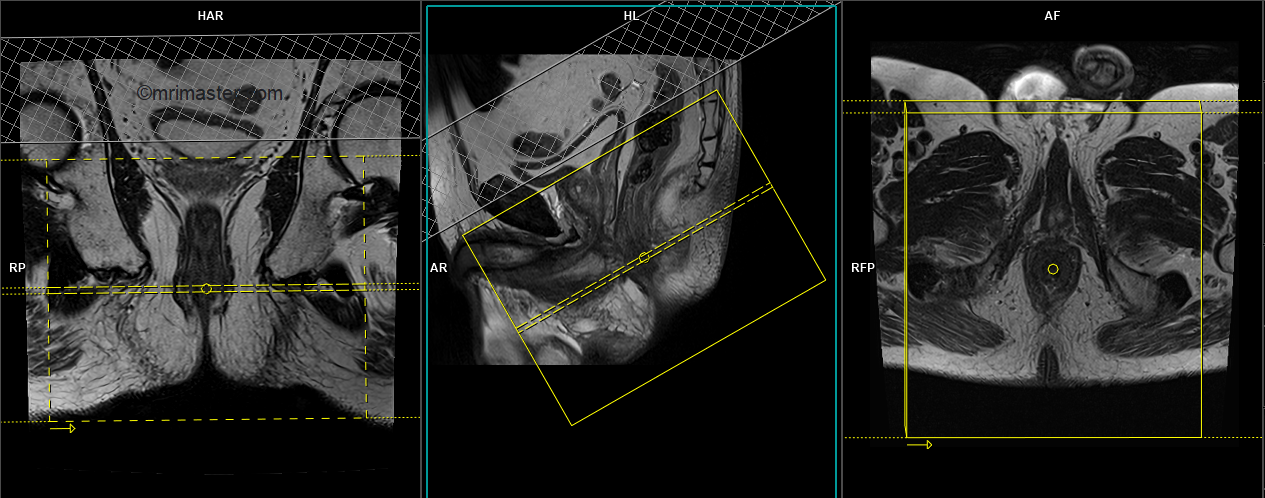 Anal fistula MRI | Perianal fistula with contrast protocol and planning