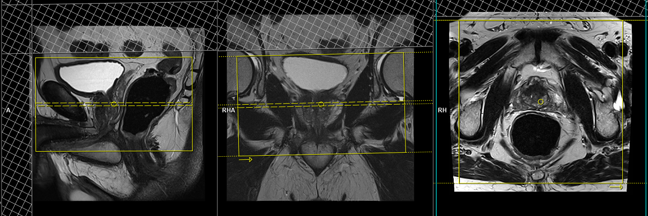 Mri Prostate Planning Dynamic Mri Prostate Protocols 8639