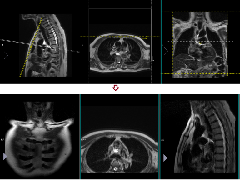 Mri Sternum Or Sternoclavicular Joint Planning And Protocols And