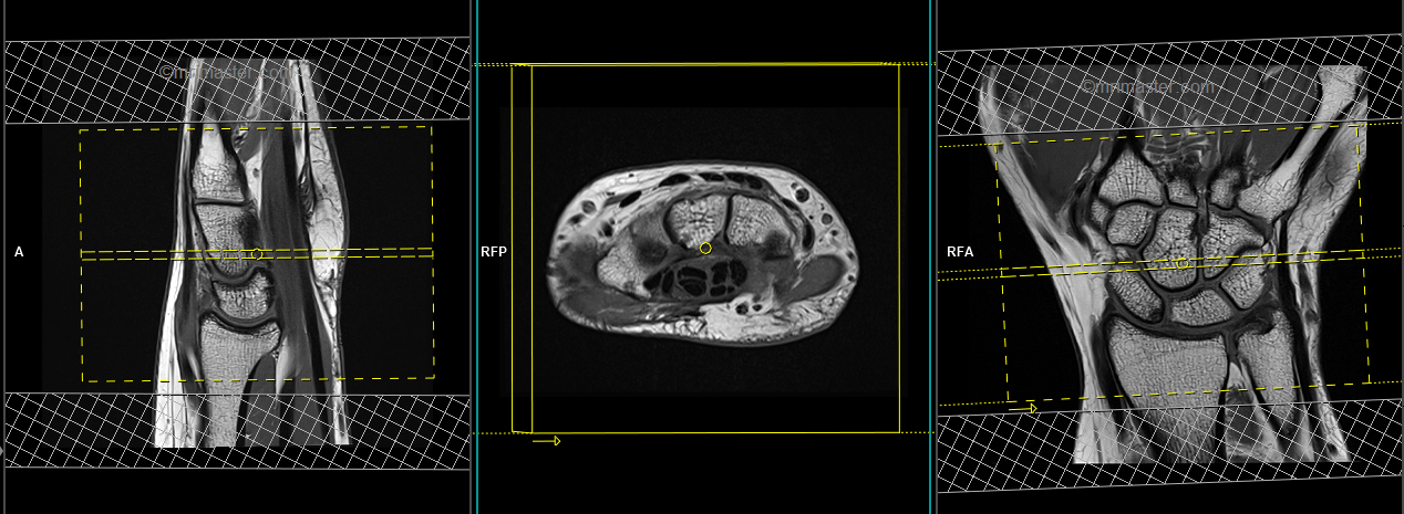 Wrist MRI Planning MRI Wrist Protocols Indications For Wrist Joint