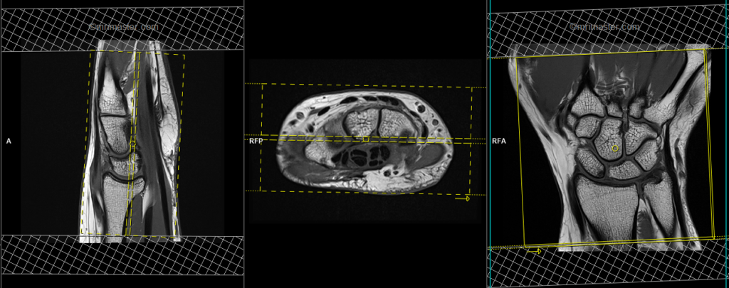 Frontal Plane Mri