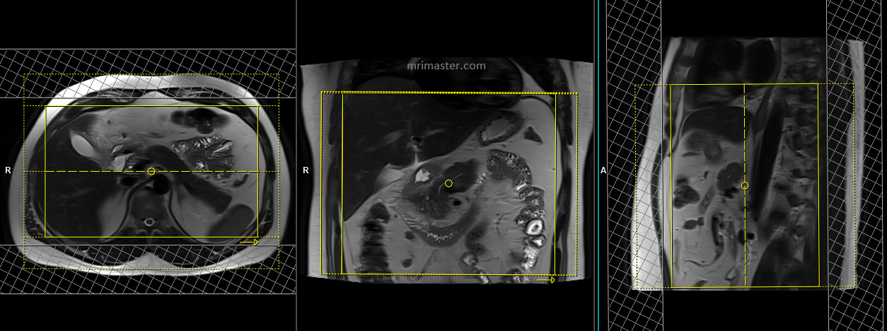 Pancreas MRI Planning | MRI Pancreas Protocols | Indications For MRI ...