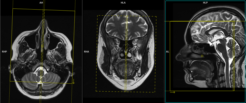 planning of MRI face sagittal scans