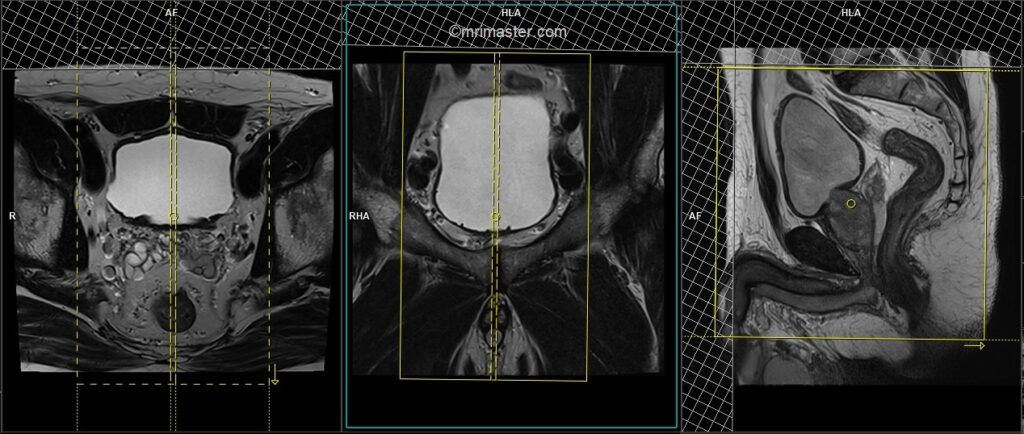 planning of urinary bladder mri sagittal images