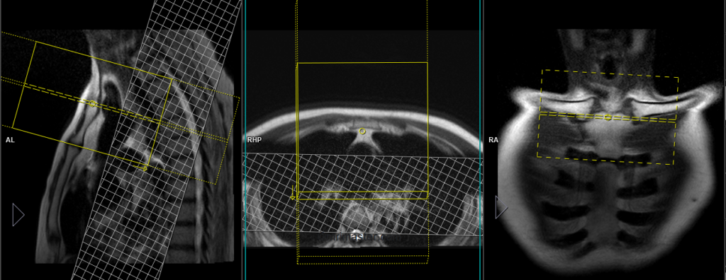 Mri Sternoclavicular Joint Protocol Planning And Incications