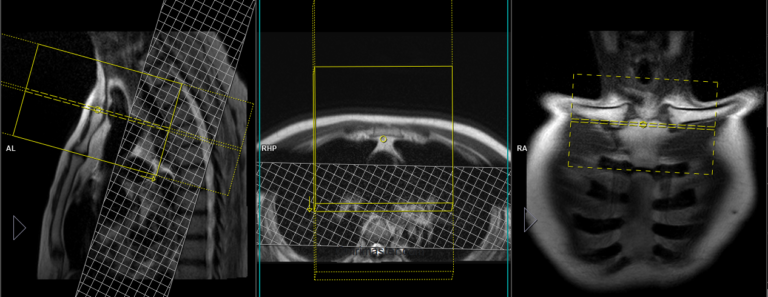 MRI Sternoclavicular Joint Protocol, Planning and Incications