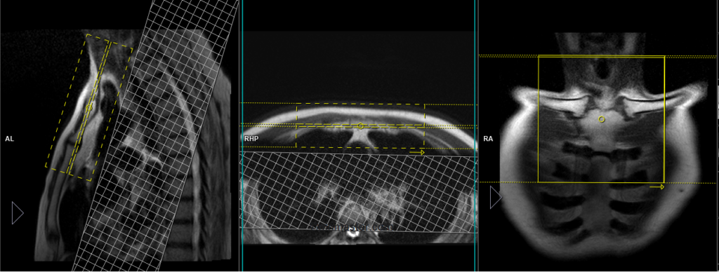 sternoclavicular joint mri planning and protocol of coronal scans