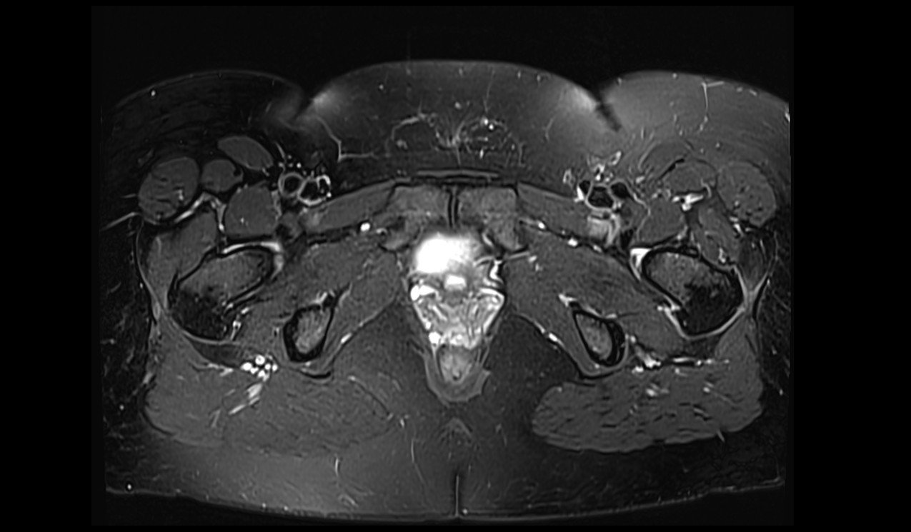 Chemical Shift Selective (CHESS) fat saturtion image pelvis Chemical Shift Selective (CHESS) fat saturtion image pelvis