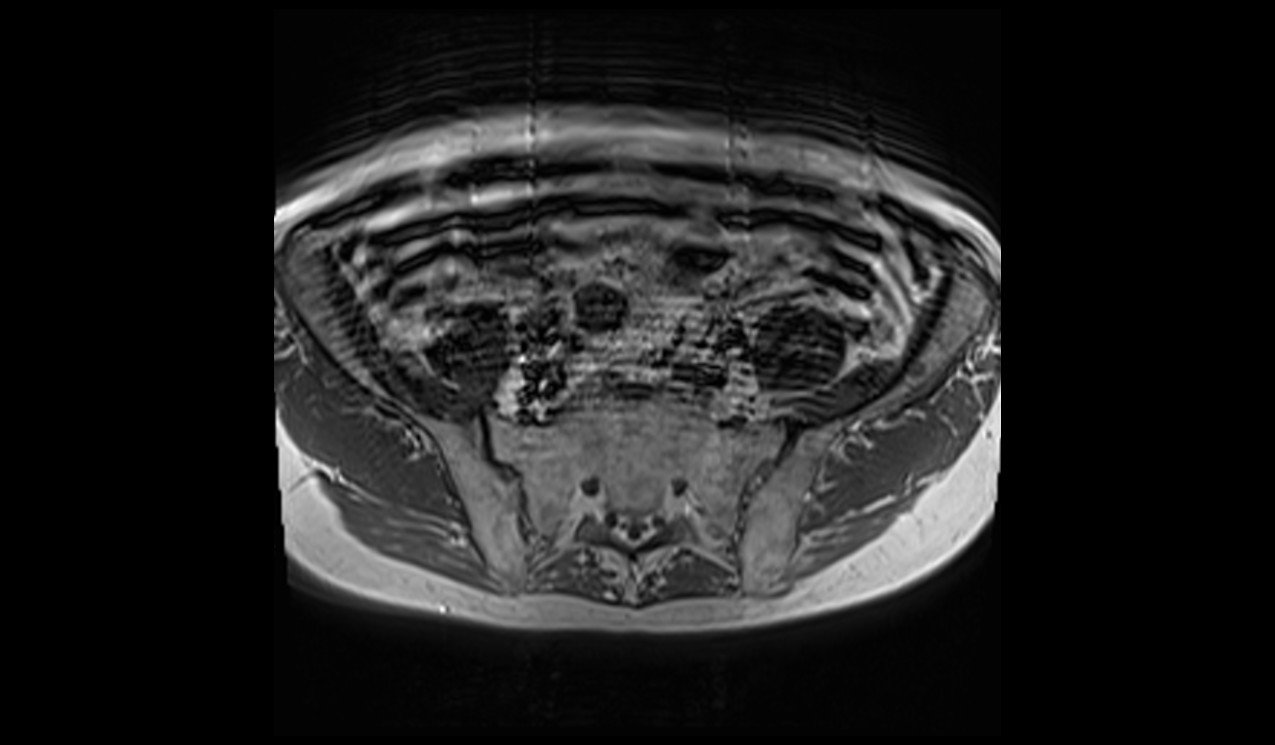 Deep Resolve Boost enhances motion artifact Deep Resolve Boost enhances motion artifact