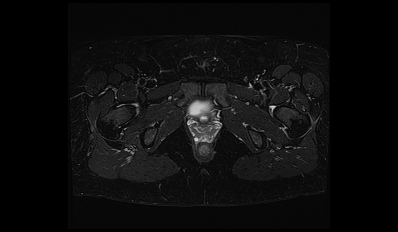 Dixon fat saturation images of pelvis 1 Dixon fat saturation images of pelvis 1