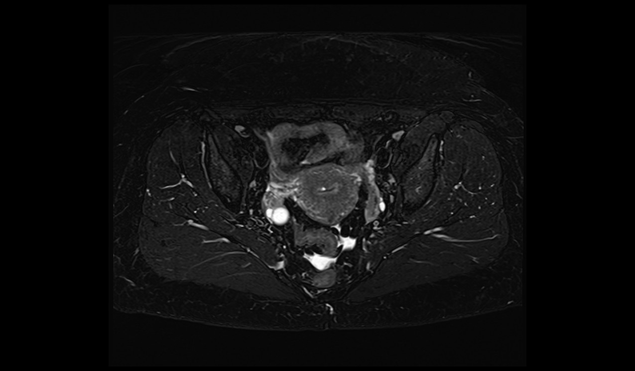 MRI fat saturation | MRI fat suppression techniques