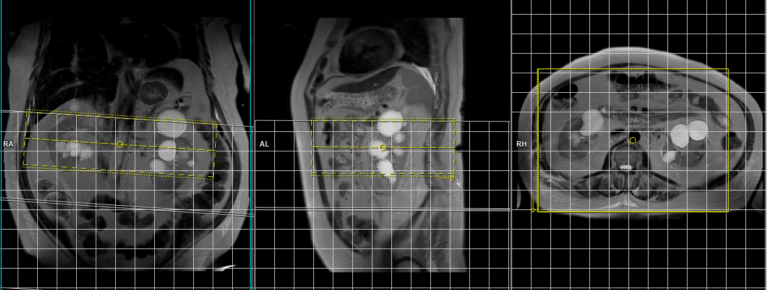 NATIVE MRI | Native Space MRI | NATIVE MRA Protocol and Planning