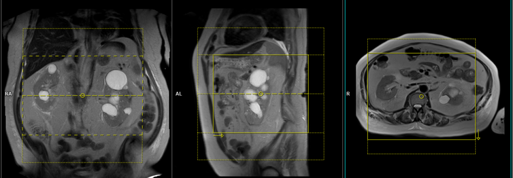 MRA NATIVE non contrast renal artery scan axial 3d images