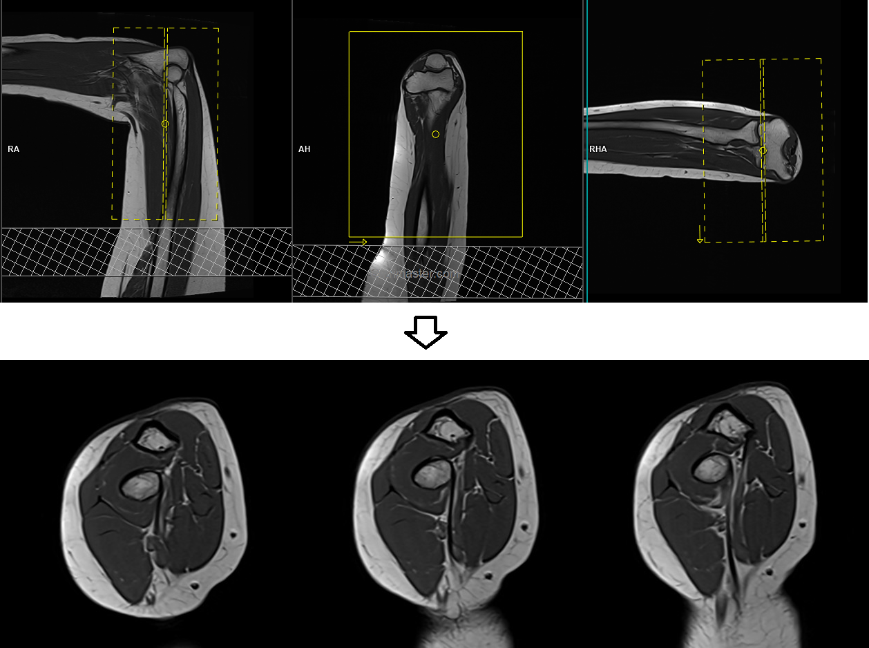 MRI FABS View |FABS View protocol and planning