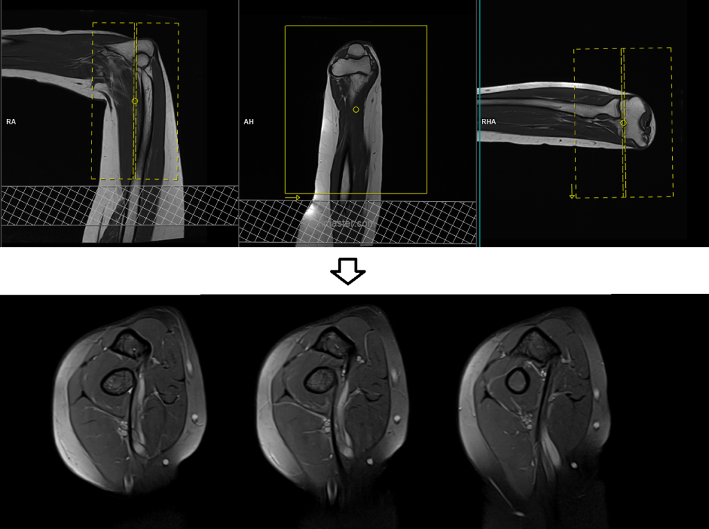 MRI FABS View |FABS View protocol and planning