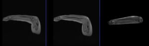 Fabs Radiography MRI FABS View |FABS View protocol and planning