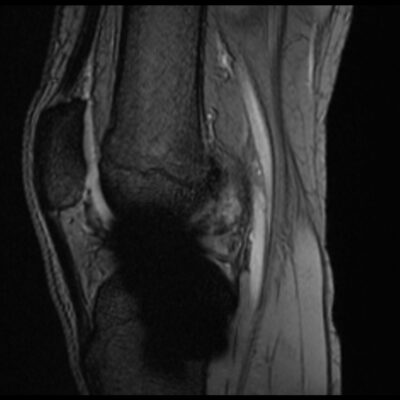 MRI Magnetic susceptibility artifact GRE knee scan