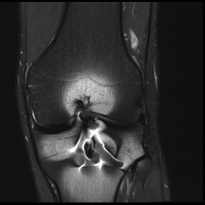 MRI Magnetic susceptibility artifact knee PD FS image
