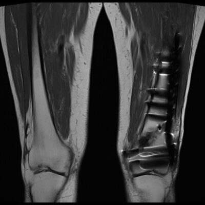 MRI Magnetic susceptibility artifact thigh