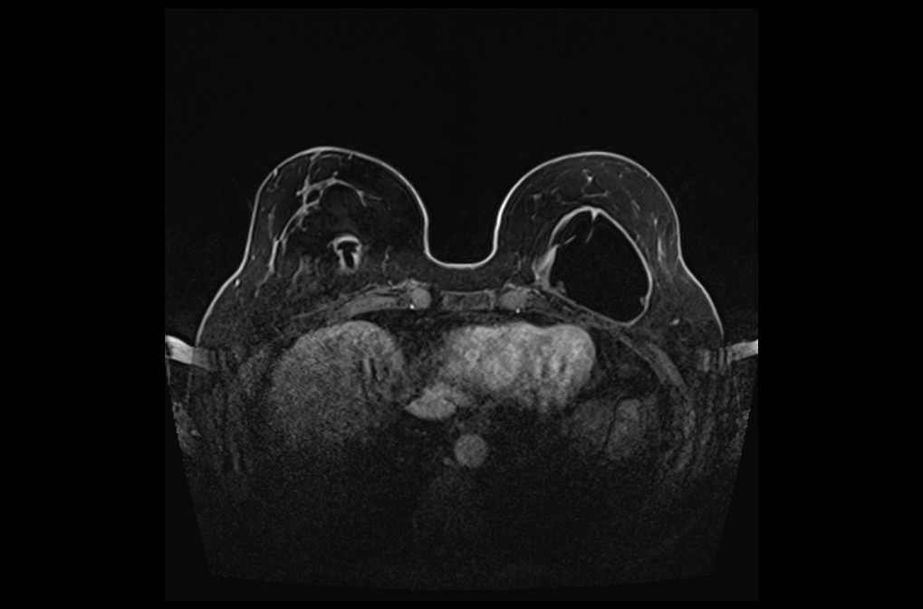 PLAN BREAST DYNAMIC 2 - mrimaster