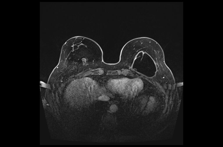 PLAN BREAST DYNAMIC 4 - mrimaster