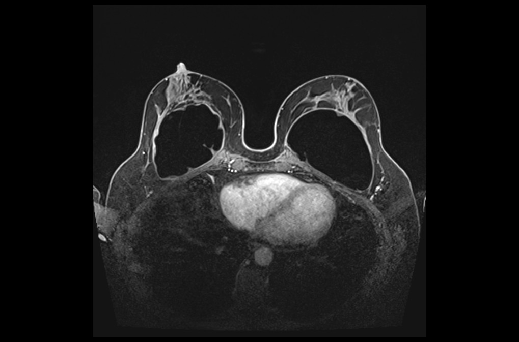 PLAN BREAST DYNAMIC 3 - mrimaster