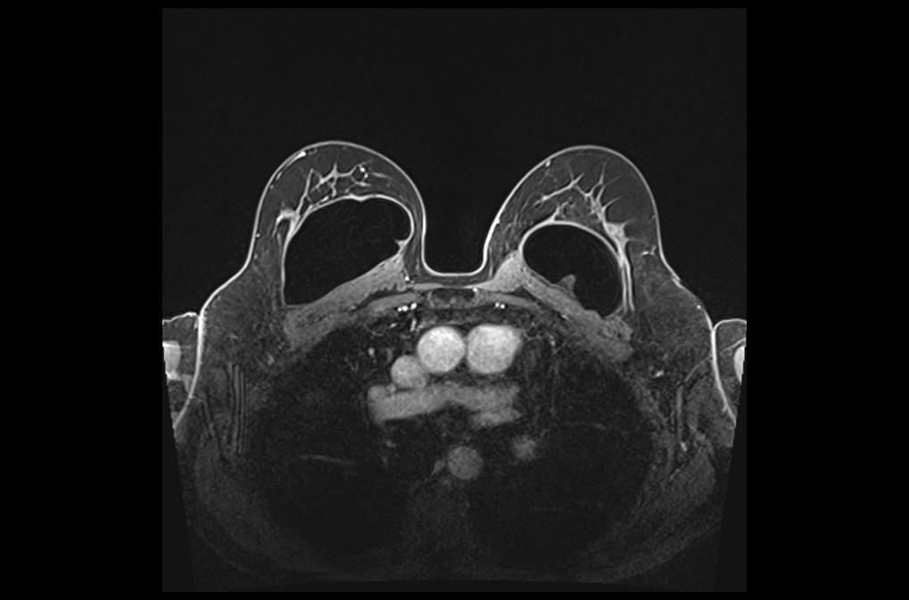 PLAN BREAST DYNAMIC 3 - mrimaster