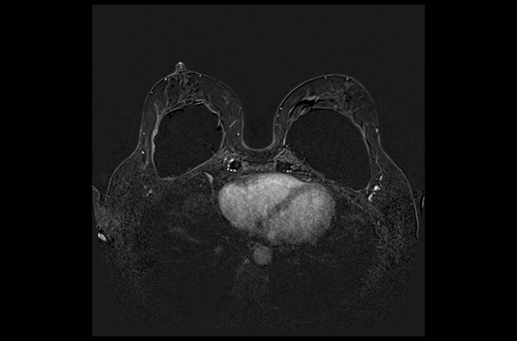 Plan Breast Dynamic Sub - Mrimaster