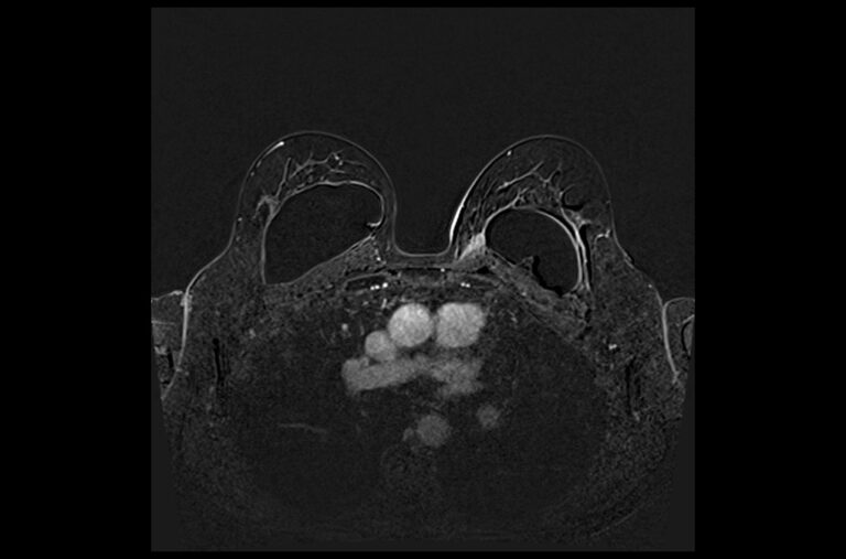 PLAN BREAST DYNAMIC SUB - mrimaster