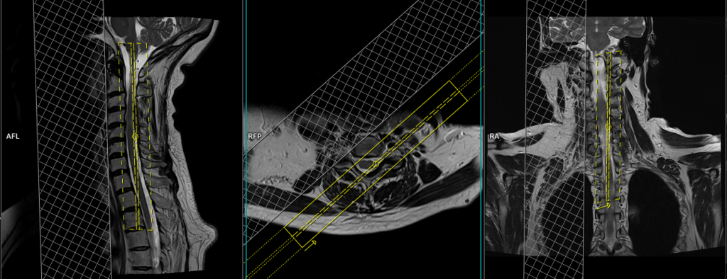 MRI cervical spine exit foramen view coronal oblique image planning LT