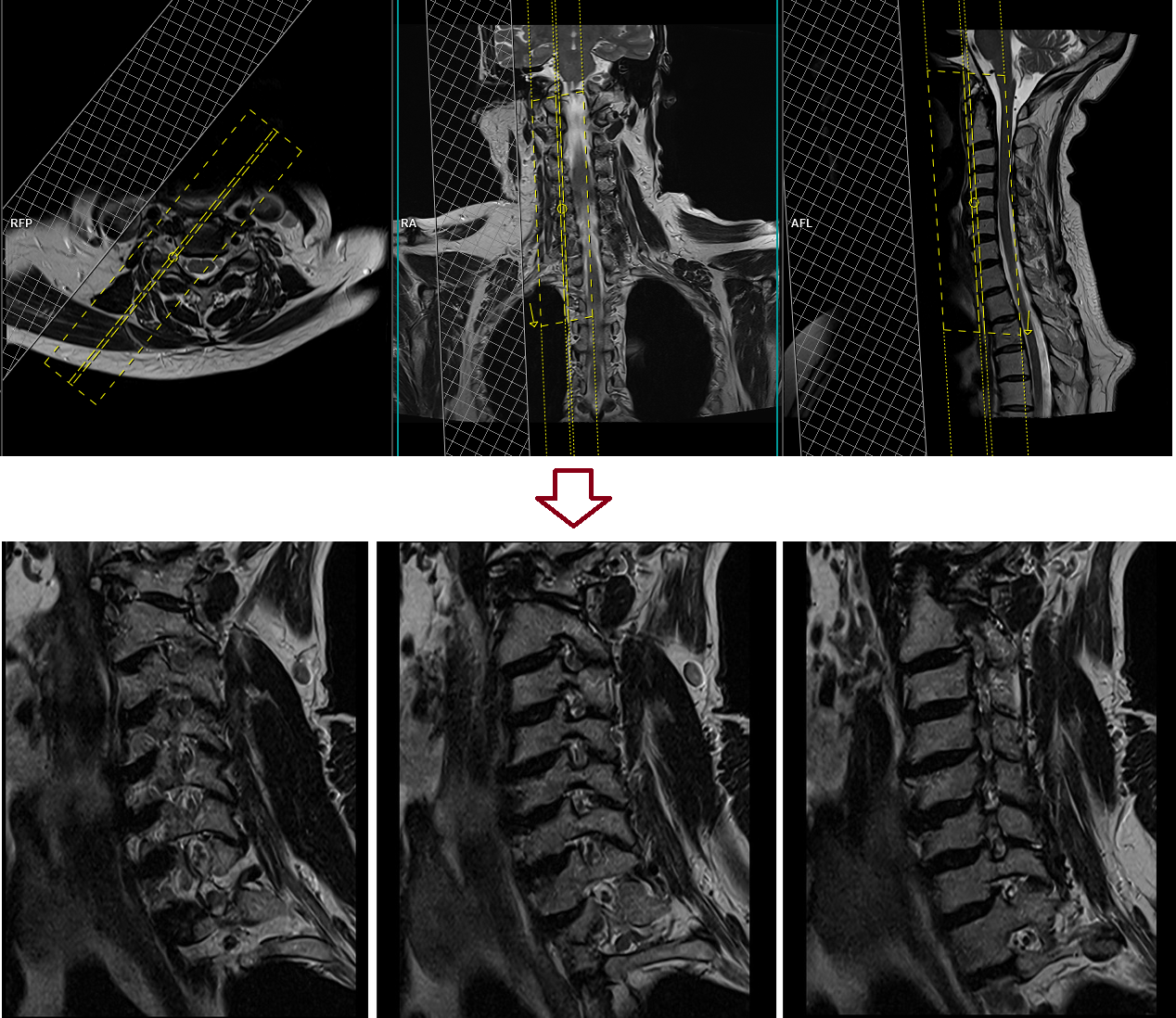 MRI cervical spine exit forearm view