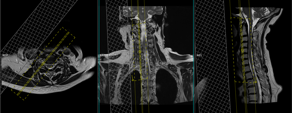 MRI cervical spine exit foramen view sagittal oblique image planning RT
