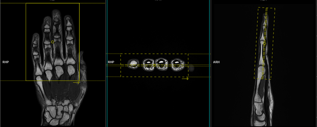 MRI fingers | Finger MRI protocol and planning