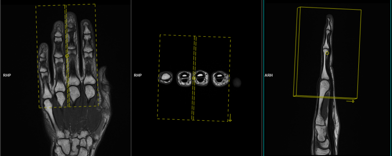 MRI fingers | Finger MRI protocol and planning