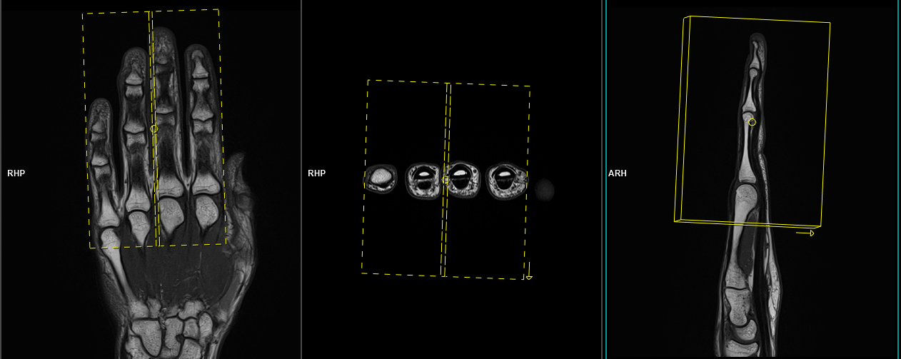 Mri Fingers 