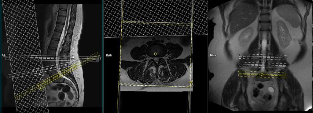 MRI lumbar spine protocol and planning of axial scans